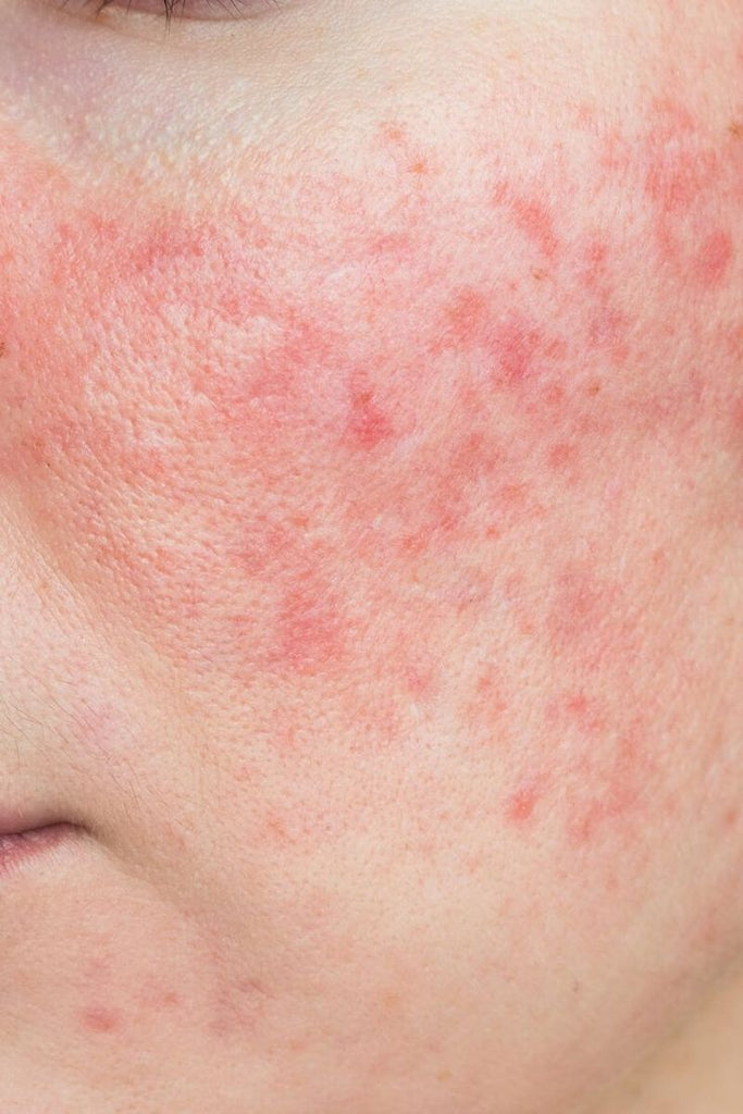 Natural Remedies that help with Rosacea